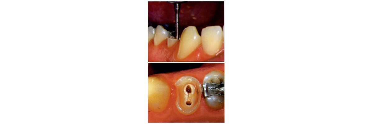Endodontie Instrumente