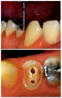 Endodontie Instrumente